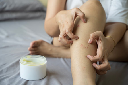 Allergic reaction, itch, dermatitis. Woman is applying cream, ointment on the swell skin against...