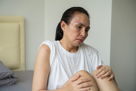 Asian woman scratch hand feel suffer from allergy while sleeping. Attractive girl sits on bed in bedroom suffering from itching arm skin allergic reaction to insect bites, dermatitis.の写真素材
