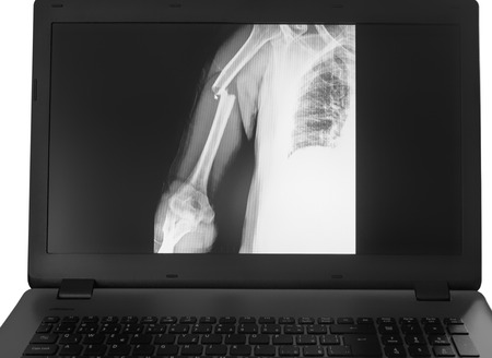 X-ray image of broken arm on monitor of pc on the white background.