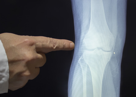An xray of a knee with a hand of doctor witch pointing to a fractureの写真素材