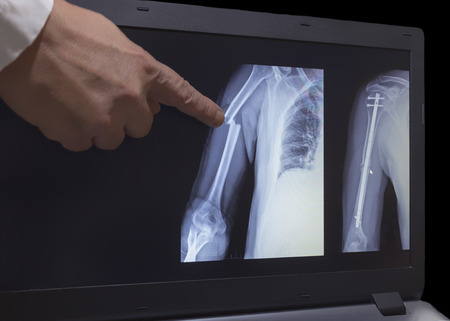 On the monitor screen is displayed an xray of fracture of a hand with the hand of a doctor pointing to a fracture. The second image on the screen is hand after operation with titanium screws.の写真素材