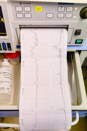 Valencia, Spain - October 25, 2018: Graphic with electrocardiogram of a pregnant woman during a...