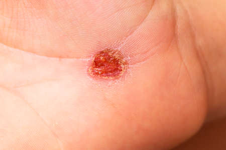 Detail of an open abrasive wound on the hand with the skin oozing serum.の写真素材