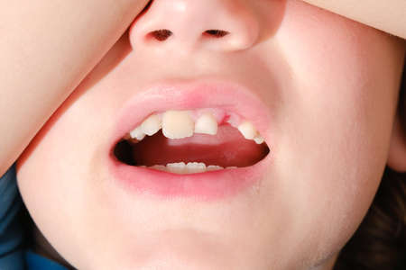 A child lost a baby tooth, shows it with his mouth open.