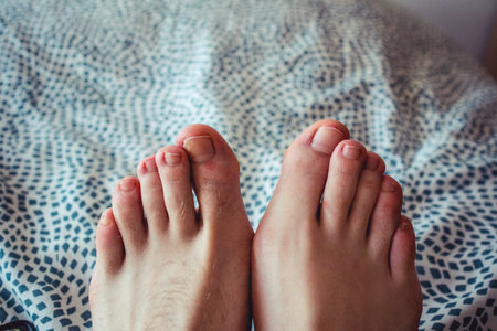 one hairy and ugly foot with a broken nail compared with a beautiful feetの写真素材
