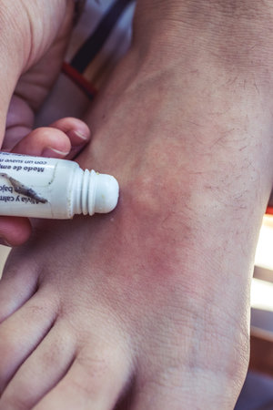 A close up oh a hand putting cream on his foot to calm the pain of an insect bittenの写真素材