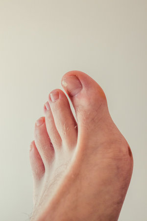Ugly feet with a broken nail and hairy with big toe.の写真素材