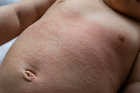The baby is experiencing a red, itchy rash on their chest and abdomen. The rash appears as patches of inflamed, irritated skin that may be accompanied by intense itching. It is localized specifically on the baby's chest and abdomen, covering areas of the skin in these regions. The redness and itchiness can cause discomfort and distress for the baby. It is important to identify the underlying causes of the rash, which could range from allergic reactions to skin conditions or infections.の写真素材