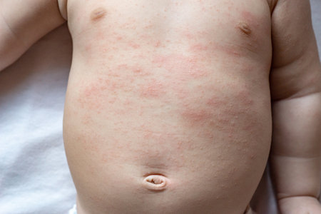 Close up of baby boy with acne on his belly. Children health care concept.の写真素材