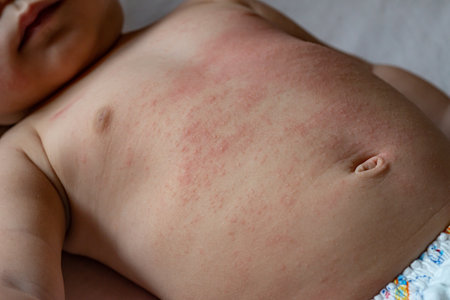 The baby is experiencing a red, itchy rash on their chest and abdomen. The rash appears as patches of inflamed, irritated skin that may be accompanied by intense itching. It is localized specifically on the baby's chest and abdomen, covering areas of the skin in these regions. The redness and itchiness can cause discomfort and distress for the baby. It is important to identify the underlying causes of the rash, which could range from allergic reactions to skin conditions or infections.の写真素材