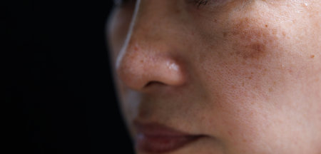 close up a small pimple on a woman's noseの写真素材