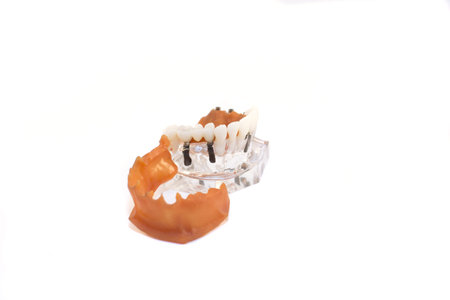 glass jaw model with implanted dentures. Isolatedの写真素材