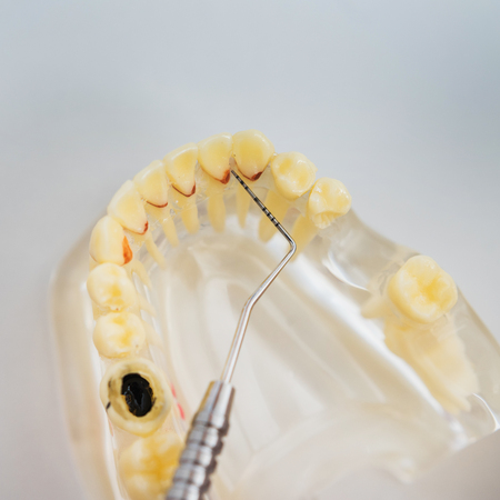 doctor shows the instrument on caries in the teeth