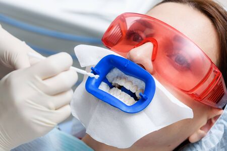 there is a preparation of the oral cavity to bleaching with the help of an ultraviolet lamp. Close-upの写真素材