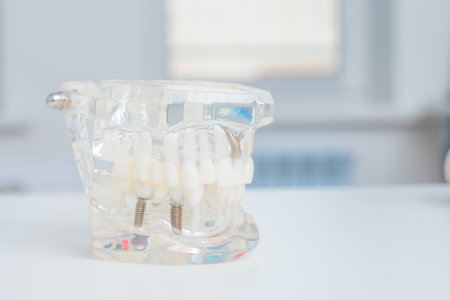 A model of teeth with implants lies on a table in office
