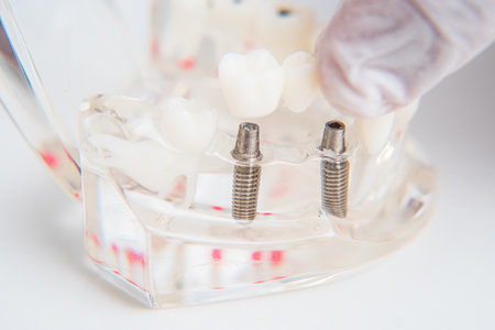 the doctor orthodontist shows how to insert the implant. Macroの写真素材