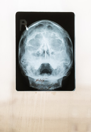 Closeup of a childs skull x-ray on a misty windowの写真素材