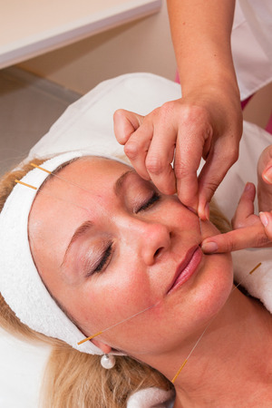 TENERIFE, SPAIN, JULY 2014: Aesthetic medicine and cosmetology.Woman undergoing acupuncture treatment in beauty clinic on Adeje Sur.のeditorial素材