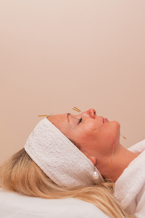 TENERIFE, SPAIN, JULY 2014: Aesthetic medicine and cosmetology.Woman undergoing acupuncture treatment in beauty clinic on Adeje Sur.のeditorial素材