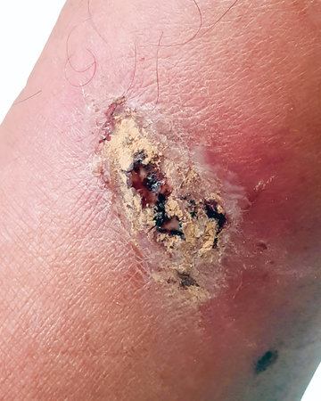 Chronic Infected Wound on Shin with Topical Powder Treatment on White Background