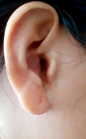 a human ear affected by a bacterial infection showing visible pus or discharge along the ear canal and surrounding skin. There is also redness and some skin peeling indicative of inflammation and infection.の写真素材
