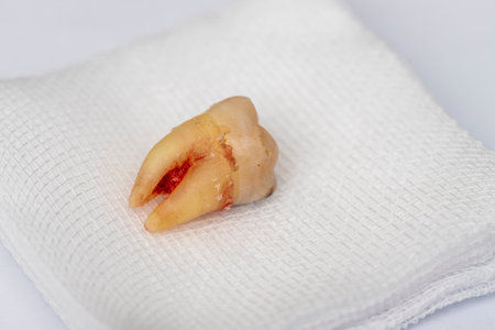 A decayed molar tooth is extracted. The blood hasn't dried yet. Lie down on white gauze. Isolated on a white background. Selective focus.の写真素材