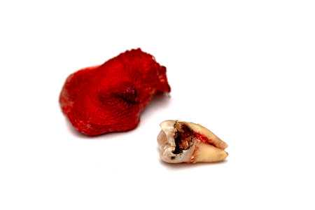 One molar tooth decay extracted and placed on a white background. The root of the tooth is not long,...