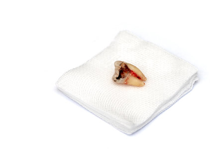 A decayed molar tooth is extracted. The blood hasn't dried yet. Lie down on white gauze. Isolated on a white background. Selective focus.の写真素材