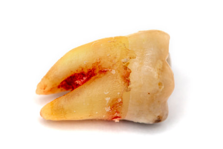 Close up shot of a molar tooth decay extracted and placed on a white background. The root of the tooth is not long, there is a small amount of bleeding.   Selective focus.の写真素材