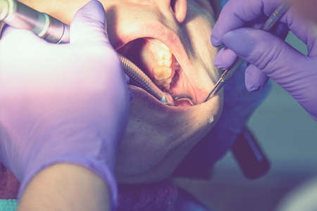 Male dentists examining and working on young female patient. Real woman in a chair at the dentist. toned.の写真素材