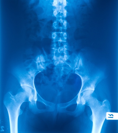 X-ray of the pelvis and spinal の写真素材