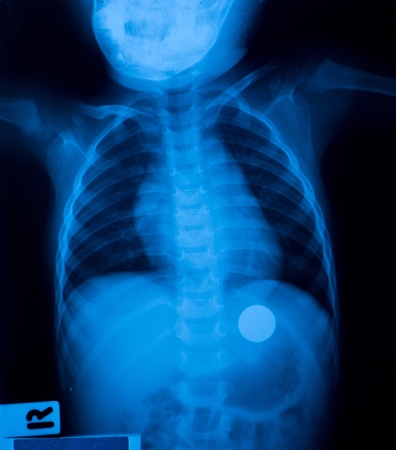X ray film  of a child who swallowed a coin