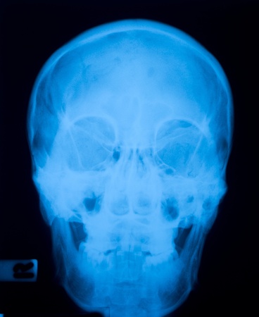 X ray film  of skull fractureの写真素材