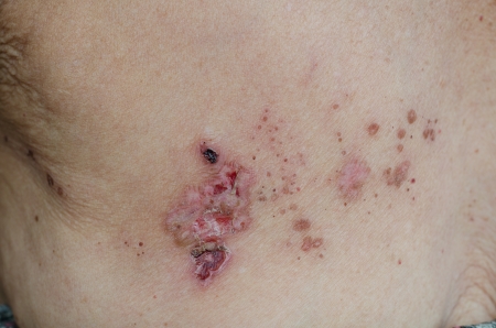 Herpes zoster