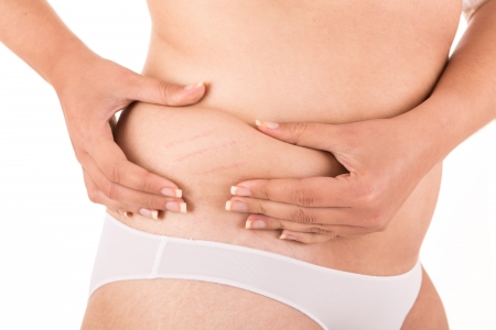 Woman showing her stretch marksの写真素材