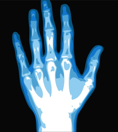 xray hand isolated on the black background のイラスト素材