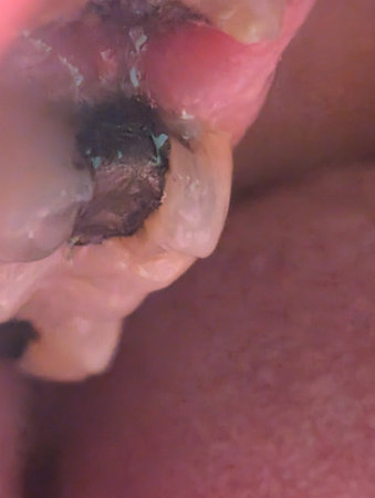 teeth filling in human mouth as medical detailの写真素材