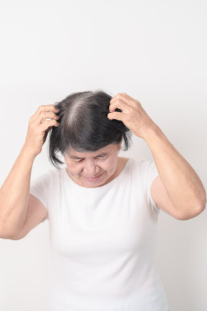 Elderly woman having itchy Scalp and Head hair, Dandruff, Dry Scalp, Skin Allergy Seborrheic dermatitis. Dermatology, Systemic lupus erythematosus, SLE, Psoriasis and Atopic Eczema rashの写真素材