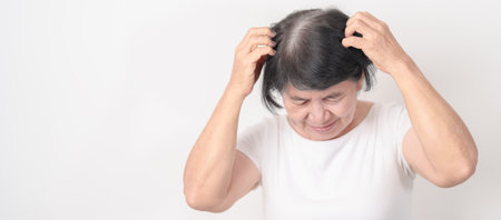 Elderly woman having itchy Scalp and Head hair, Dandruff, Dry Scalp, Skin Allergy Seborrheic dermatitis. Dermatology, Systemic lupus erythematosus, SLE, Psoriasis and Atopic Eczema rashの写真素材