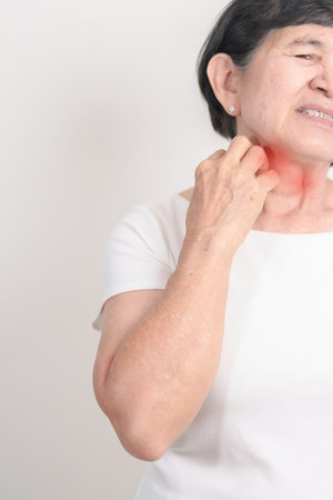 Elderly woman itching Neck and body scratching for Skin Allergy from insect bite and food dermatitis. Dermatology, Systemic lupus erythematosus, Psoriasis, Urticaria and rash Eczemaの写真素材
