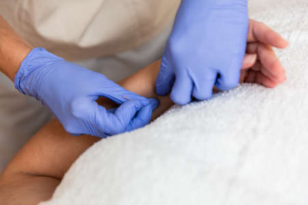 physiotherapist giving treatment with dry needling to patientの写真素材