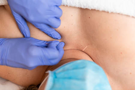 physiotherapist giving treatment with dry needling to patient on covid time