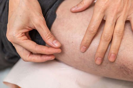 physiotherapist giving treatment with dry needling to patient with varicoseの写真素材