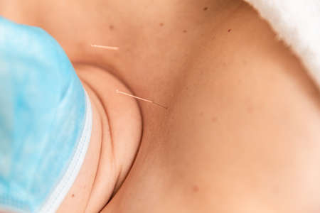 a woman rests in a physical therapists room with acupuncture needles