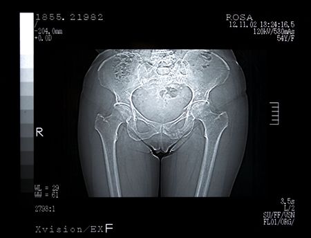 Scan of a Broken Pelvis. CT Scanの写真素材