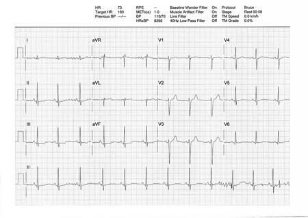 EKG or ECG result from a Treadmill Stress Test. Regular low heartbeat (73bpm) on rest phase (male, 34y).の写真素材
