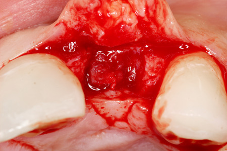actual dental implant surgeryの写真素材