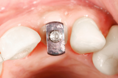 tooth surgery implant viewの写真素材