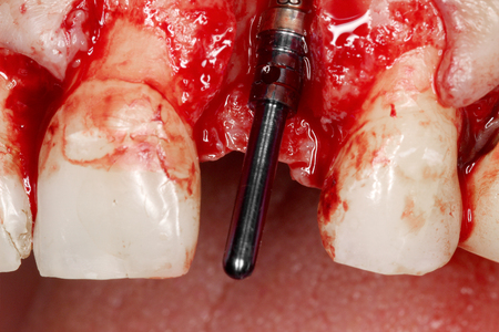 tooth surgery implant viewの写真素材