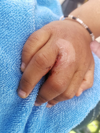 Pediatric edema that excess fluid trapped within tissues of a young kid.の写真素材